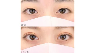 二重埋没 TCB式二重術の症例