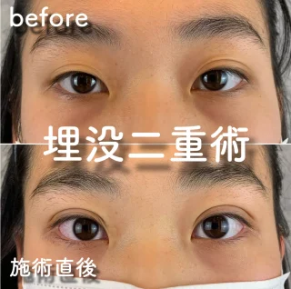 二重埋没 プレミアナチュラ法