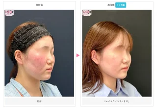 根こそぎVASER脂肪吸引
