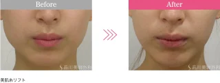 美肌糸リフト