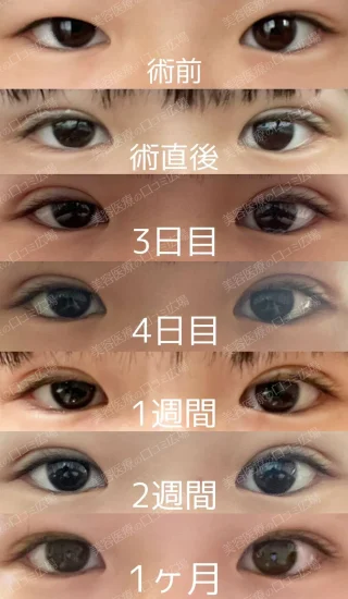 二重埋没3点