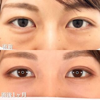 切らない目の下のクマ取り・目の下のたるみ（ふくらみ）取り