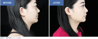 脂肪破壊 スルリム注射