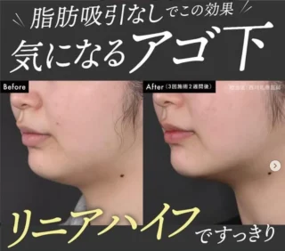 脂肪溶解リニアハイフ