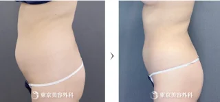 腹部・腰脂肪吸引