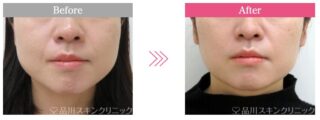えらボトックス
