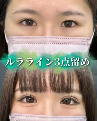 ラライン3点留め