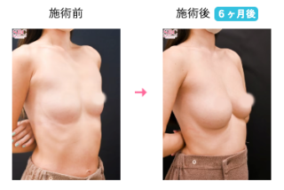 豊胸・バストの修正