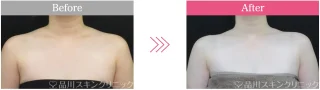 肩ボトックス