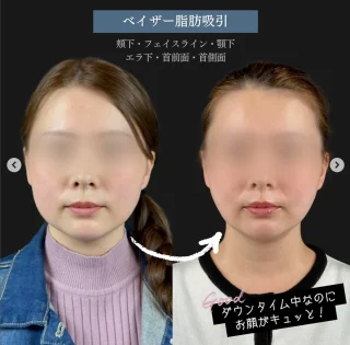 顔の脂肪吸引