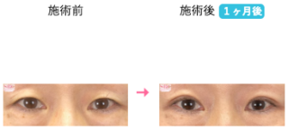 切らないまぶたのリフトアップ 他