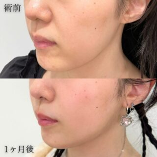 TCB小顔リフト