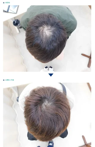 内服薬による薄毛の改善事例(30代男性・8ヶ月後)
