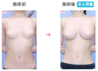  Aquicell（アキーセル）併用コンデンスリッチ(脂肪注入豊胸)