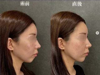 ネビュラリフト、ネビュラ式1day美肌リフト