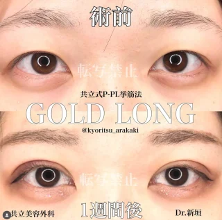 共立式P-PL挙筋法ゴールドロング