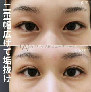 二重埋没3ループ法