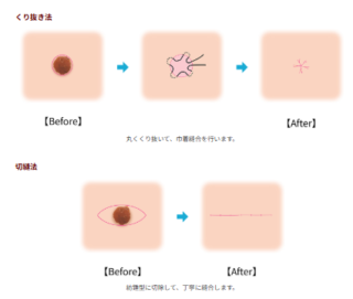 青森タウン形成外科クリニック　ほくろの除去手術　施術メニュー画像