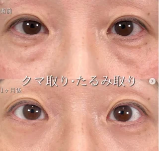 切らない⽬の下のクマ取り・たるみ取り