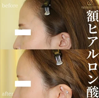額のヒアルロン酸注入