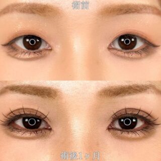 二重埋没法