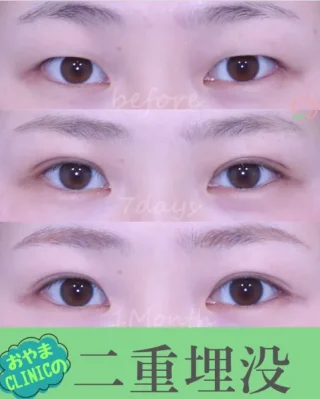 二重埋没
