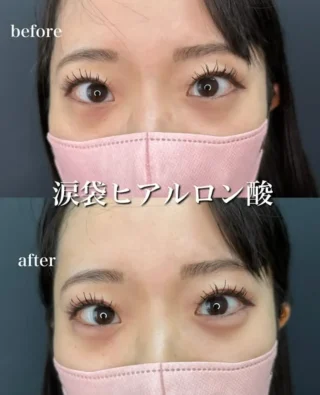 涙袋ヒアルロン酸