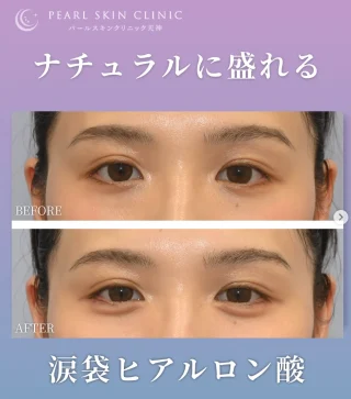 涙袋ヒアルロン酸
