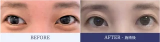 二重埋没 2点留め