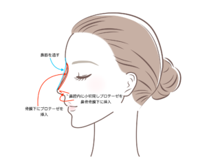 隆鼻術イラスト