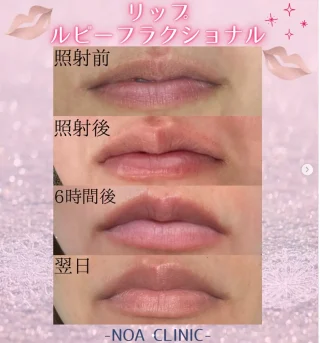リップルビーフラクショナル