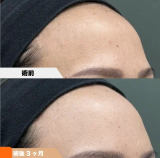 前額部 PRPF注入療法