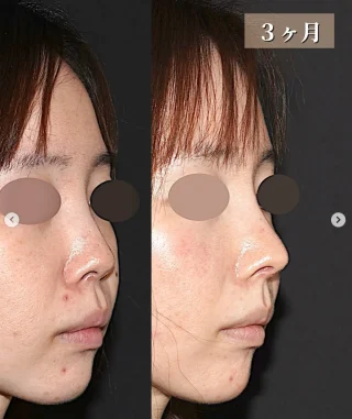 鼻尖形成、鼻中隔延長（肋軟骨）、軟骨移植、破砕軟骨2点