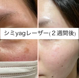QスイッチYagレーザー