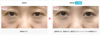 裏ハムラ法