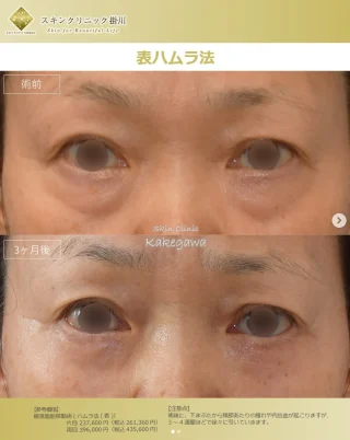 表ハムラ法