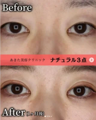 二重埋没法 ナチュラル3点