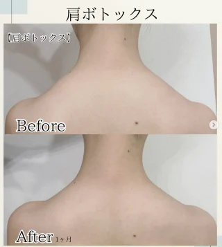 肩ボトックス