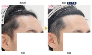 他院修正・密度UP