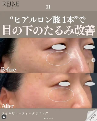 ヒアルロン酸注射