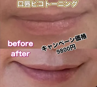 口唇ピコトーニング
