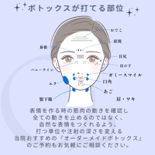 ボトックスイラスト