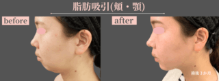 脂肪吸引(顔・顎)