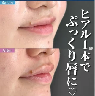 唇ヒアルロン酸