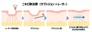 佐々木皮膚科　山形県　サブシジョン
