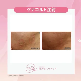 ケナコルト注射
