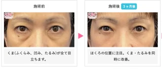 切開ハムラ法