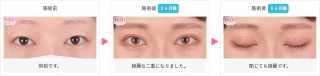 二重整形