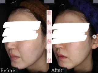 脂肪溶解注射