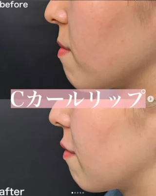唇ヒアルロン酸＋口角ボトックス